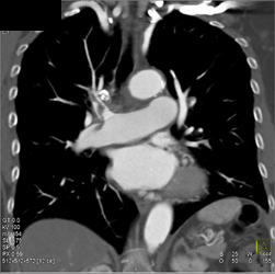 Pulmonary Embolism - CTisus CT Scan