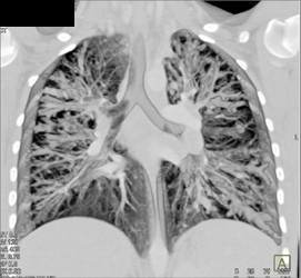 Cystic Fibrosis - CTisus CT Scan