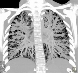 Cystic Fibrosis - CTisus CT Scan