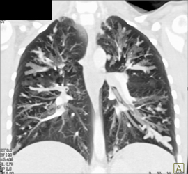 Cystic Fibrosis - CTisus CT Scan