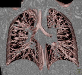 Cystic Fibrosis - CTisus CT Scan