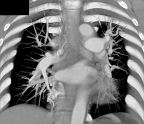 Increased Pulmonary Arterial Flow to Left Lung - CTisus CT Scan