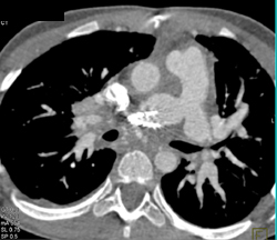 Patent Stent in the Right Pulmonary Artery - CTisus CT Scan