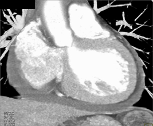 Diseased LAD and RCA - CTisus CT Scan