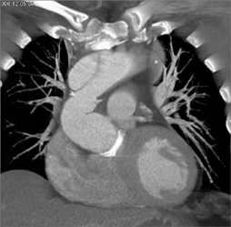 Type A Dissection - CTisus CT Scan