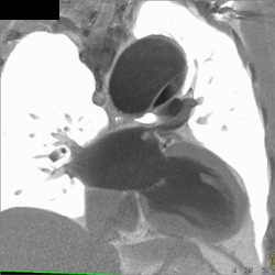 Type A Dissection - CTisus CT Scan