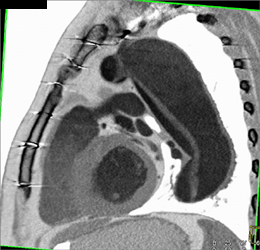 Type A Dissection - CTisus CT Scan