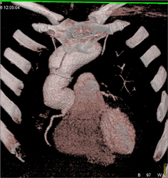 Type A Dissection - CTisus CT Scan