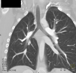 3D Imaging of the Airways Using Different Rendering Techniques - CTisus CT Scan