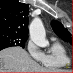 Small Right Pulmonary Artery - CTisus CT Scan