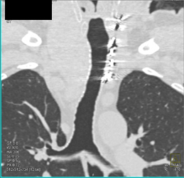 Patent Airways - CTisus CT Scan