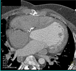 Dilated Left Ventricle - CTisus CT Scan