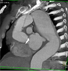 Type A Dissection - CTisus CT Scan