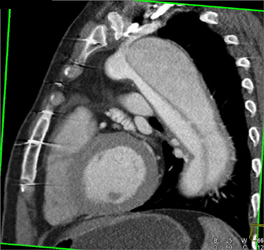 Type A Dissection - CTisus CT Scan