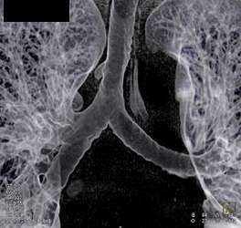 Tracheal Bronchu - CTisus CT Scan