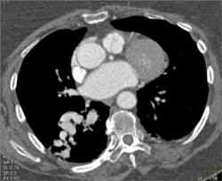 Pulmonary Arteriovenous Malformation (PAVM) - CTisus CT Scan