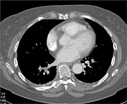 Pulmonary Embolism - CTisus CT Scan