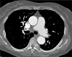 Pulmonary Embolism With Pulmonary Infarct - CTisus CT Scan