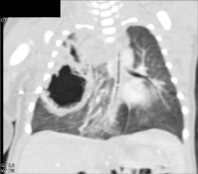 CAM -cystic Adenomatoid Malformation - CTisus CT Scan