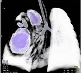 Pulmonary Embolism - CTisus CT Scan