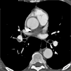 Pulmonary Embolism - CTisus CT Scan