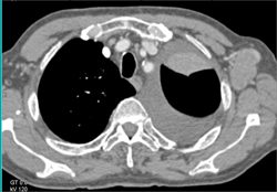 Tumor Encasement of the Left Hilum Due to Lymphoma. Axillary Nodes Are Also Seen - CTisus CT Scan