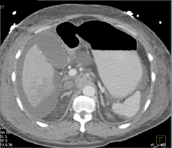 Hepatoma Invades the Inferior Vena Cava (IVC) and Extends Into the Atrium - CTisus CT Scan