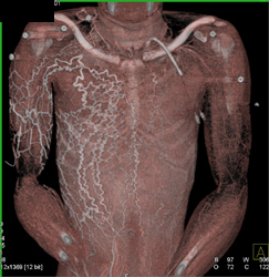 Collaterals in the Chest Wall Shown With Varying Lighting Models - CTisus CT Scan