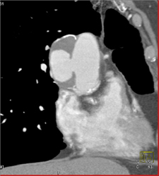 Ulceration of the Aortic Arch - CTisus CT Scan