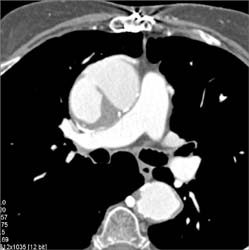 Type A Dissection - CTisus CT Scan