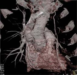 Type A Dissection - CTisus CT Scan