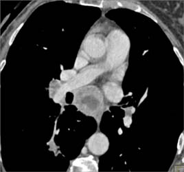 Lung Cancer With Necrotic Nodes - CTisus CT Scan