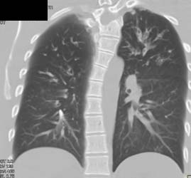 Mai Infection - CTisus CT Scan