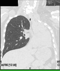 Occlusion of Left Lower Lobe Bronchus - CTisus CT Scan