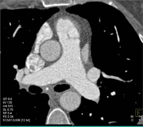 Pulmonary Valve - CTisus CT Scan