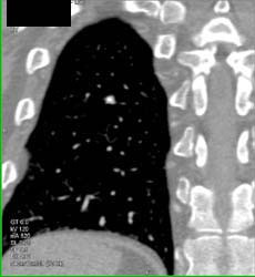 Pulmonary Nodule- Calcified - CTisus CT Scan