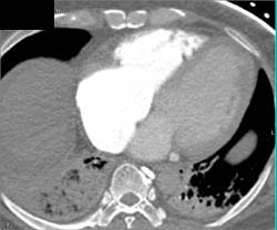 Pulmonary Embolism - CTisus CT Scan