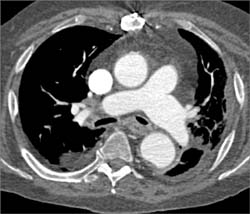 Enlarged Pulmonary Artery With Narrow Left Mainstem Bronchus - CTisus CT Scan