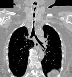 Tracheal Stenosis - CTisus CT Scan