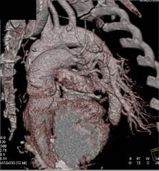 Sites of Failed Bypass - CTisus CT Scan