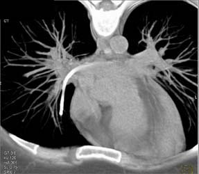 Broken Catheter in Pulmonary Artery - CTisus CT Scan