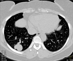 Multiple Renderings of a Pulmonary Arteriovenous Malformation (PAVM) - CTisus CT Scan