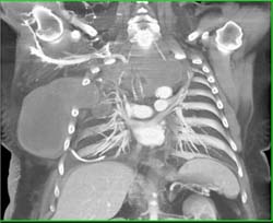 Sarcoma Involves the Mediastinum and Chest Wall - CTisus CT Scan