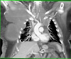 Sarcoma Chest Wall and Mediastinum - CTisus CT Scan