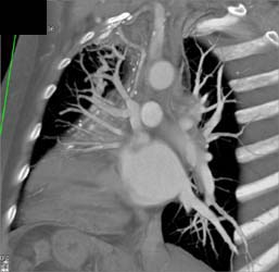 Pretty Bypass Graft and Incredible Pulmonary Arteriovenous Malformation (AVM) - CTisus CT Scan