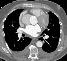 Type A Dissection - CTisus CT Scan