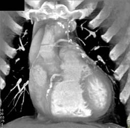 Patent Bypass Graft - CTisus CT Scan