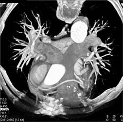 Type A Dissection - CTisus CT Scan