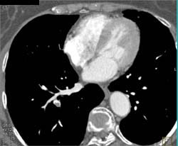 Pulmonary Embolism - CTisus CT Scan