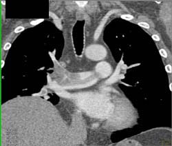 Pulmonary Embolism - CTisus CT Scan